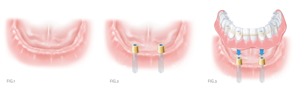 Lower Dentures Won'T Stay In Hawk Point MO 63349